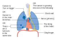 One option for stage IIB lung cancer, with T2b; but if tumor is within 2&nbsp;cm of the carina, this is stage 3