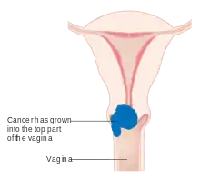 Stage 2A cervical cancer