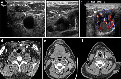Fig. 9. A 58-year-old male patient with persistence PTC at thyroid bed with hypervascular nodal metastasis. a–c Transverse greyscale and colour Doppler neck ultrasound demonstrate hypoehoic soft tissue in the left thyroid bed (white arrow in a). There are a heterogeneous enlarged lymph nodes at level 2 and 3 with markedly increased vascularity (white arrow in b and c). d–f Enhanced axial CT images of the neck demonstrate a 2.7 × 1.4&nbsp;cm hypodense soft tissue lesion anterior to the left carotid sheath (white arrow). There are left-sided enhancing abnormal and enlarged lymph nodes at cervical level 2 and 3 (black arrows).