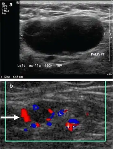 Medical ultrasonography of a soft tissue lump, showing signs of a suspected malignant lymph node:- Doppler ultrasonography that shows hyperaemic blood flow in the hilum and central cortex and/or abnormal (non-hilar cortical) blood flow- Increased focal cortical thickness greater than 3&nbsp;mm - Absence of the fatty hilum
